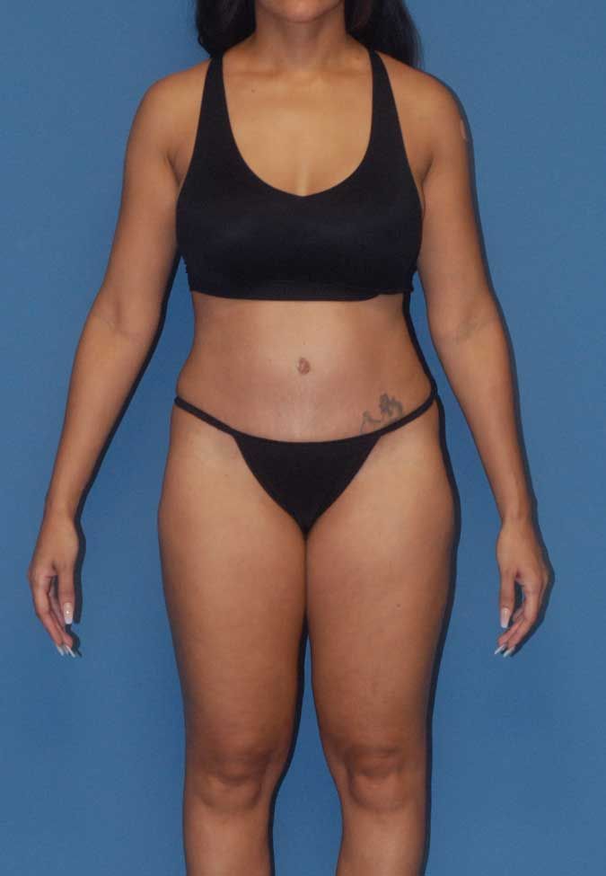 Abdominoplasty Before & After