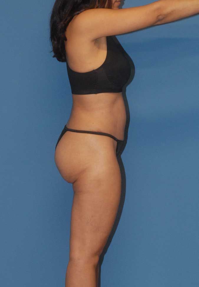 Abdominoplasty Before & After