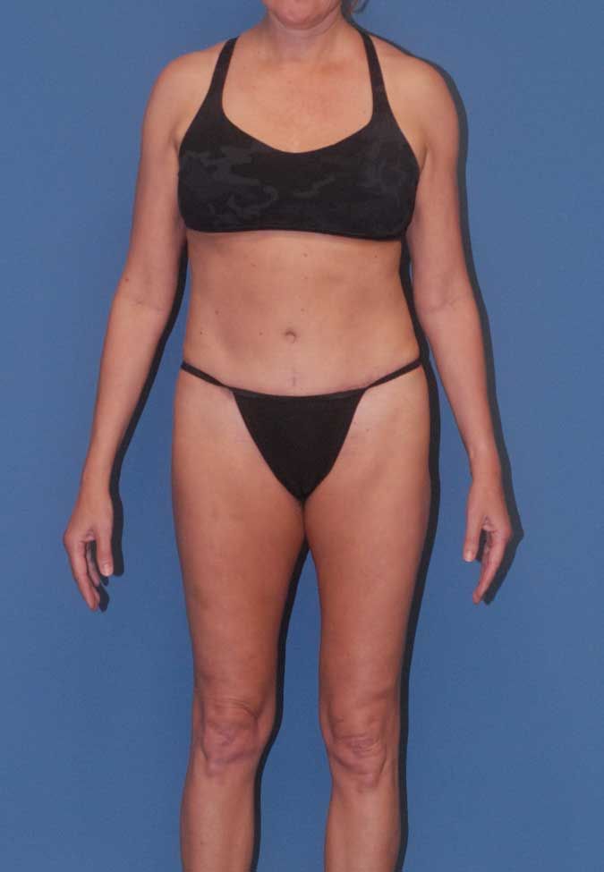 Abdominoplasty Before & After