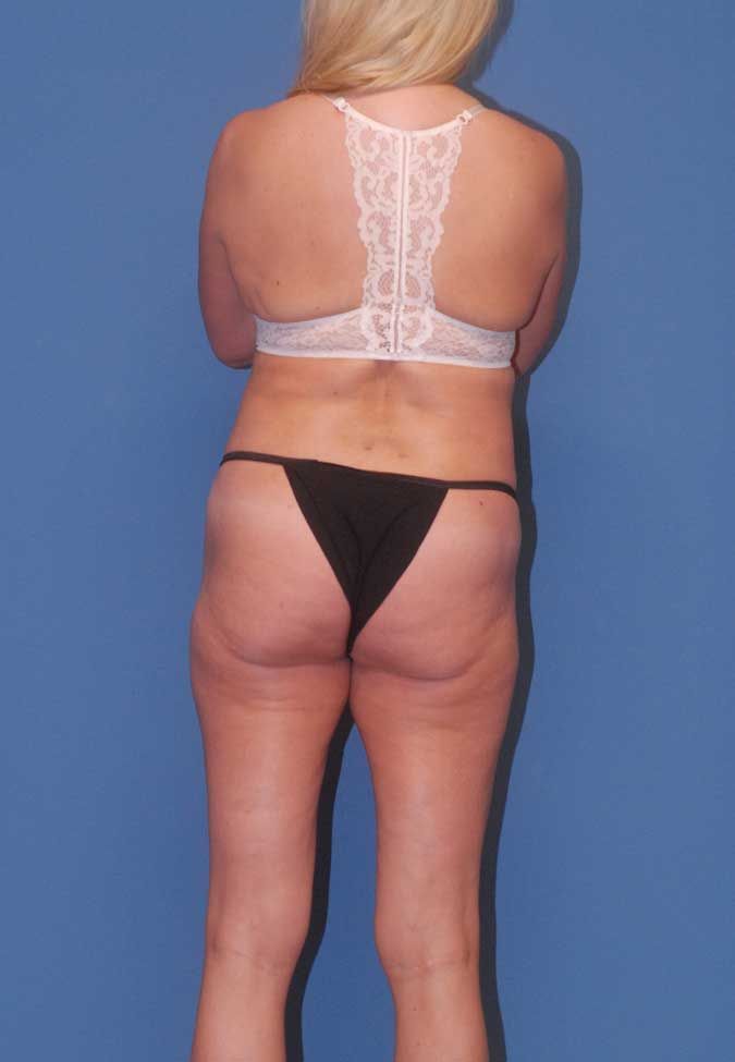 Abdominoplasty Before & After