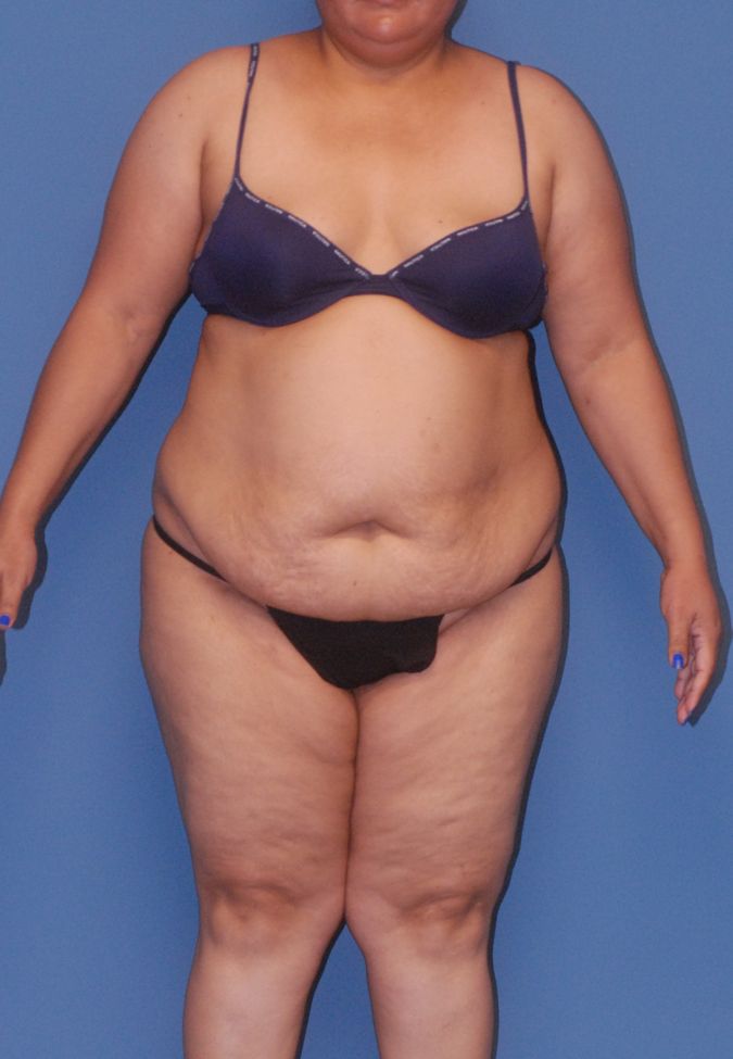 Abdominoplasty Before & After