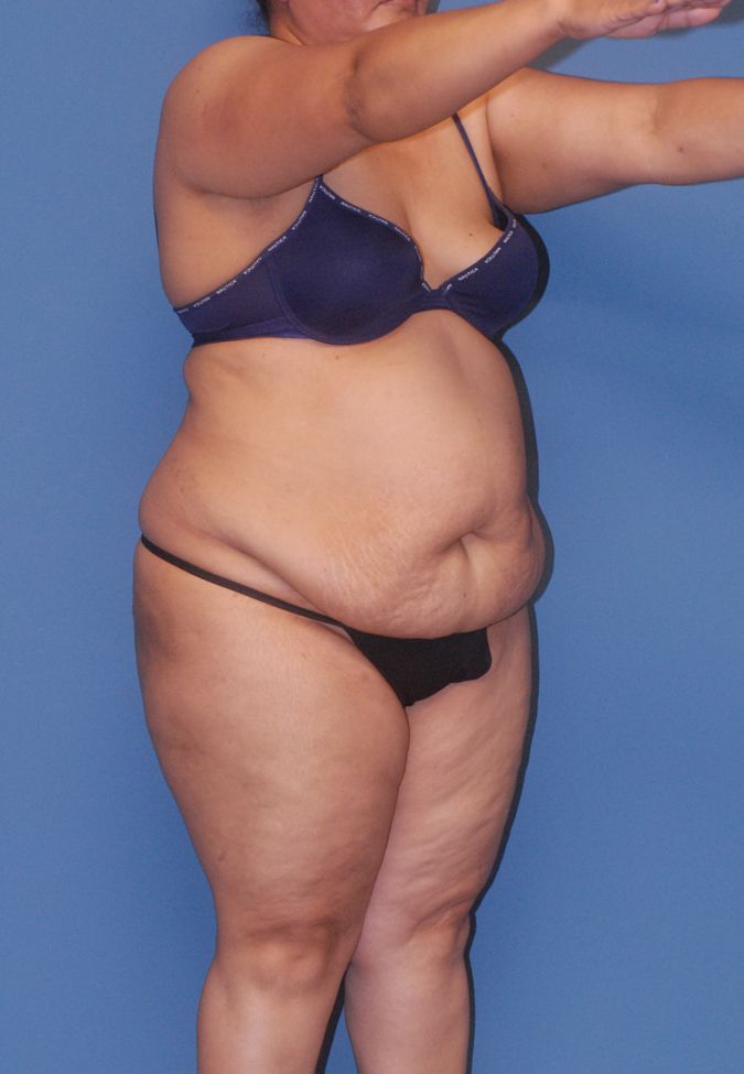 Abdominoplasty Before & After