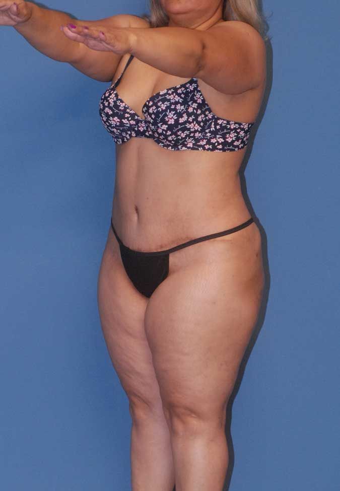 Abdominoplasty Before & After