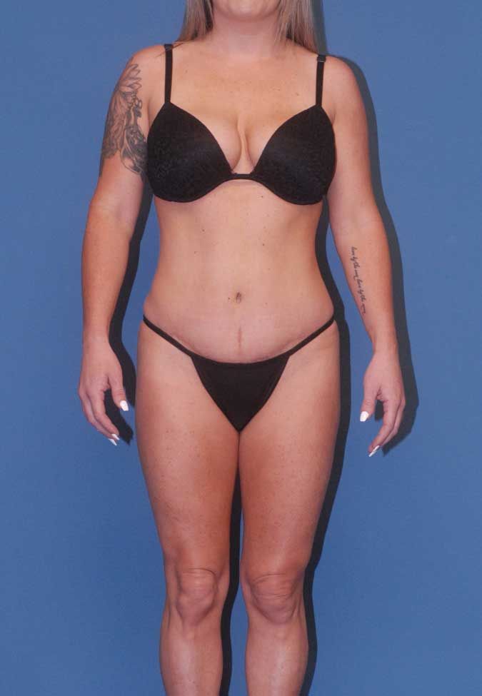 Abdominoplasty Before & After