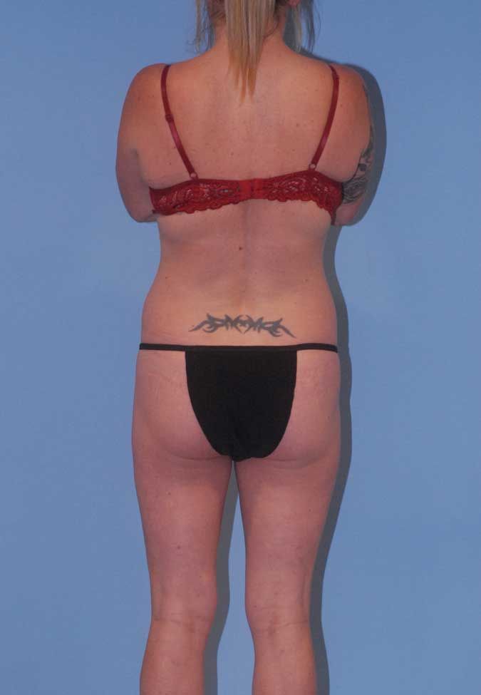 Abdominoplasty Before & After