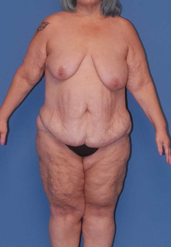 Abdominoplasty Before & After