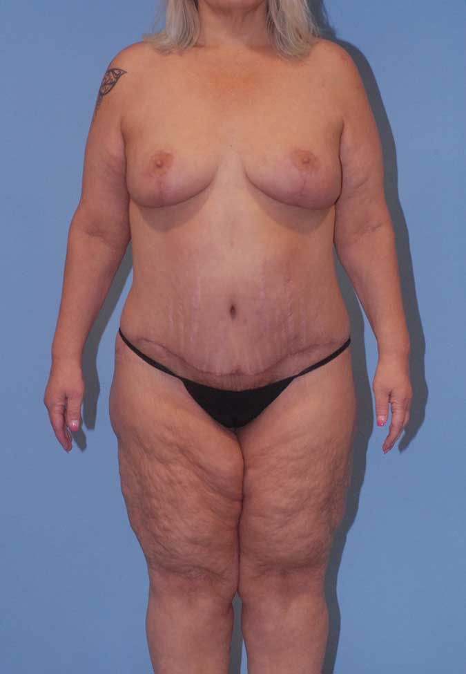 Abdominoplasty Before & After