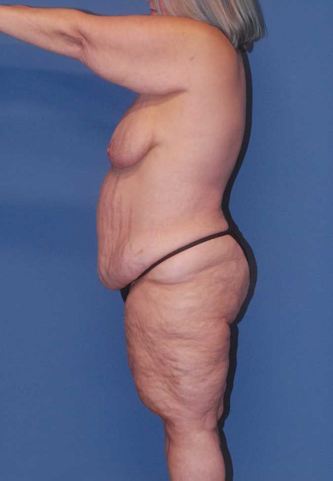 Abdominoplasty Before & After