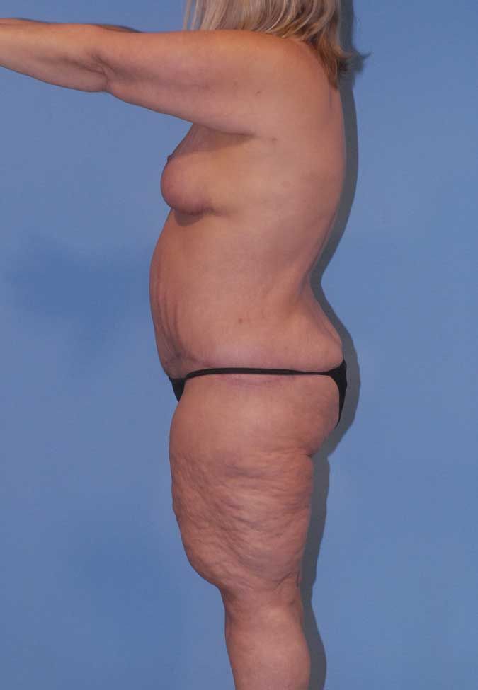 Abdominoplasty Before & After