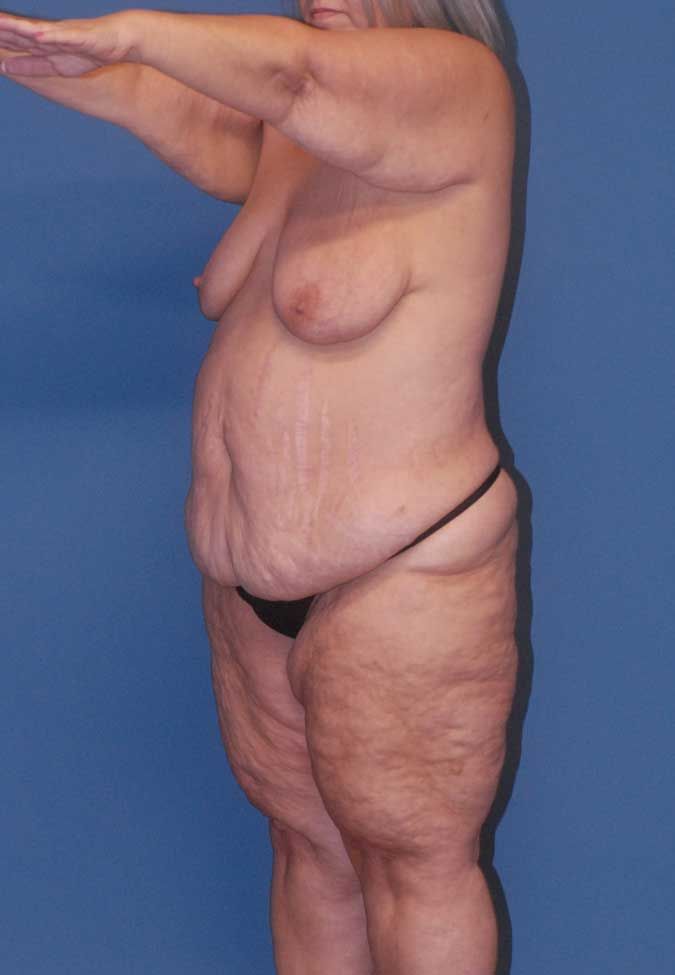 Abdominoplasty Before & After