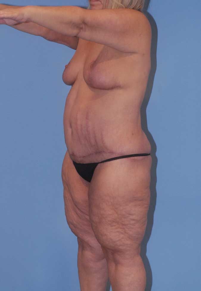 Abdominoplasty Before & After