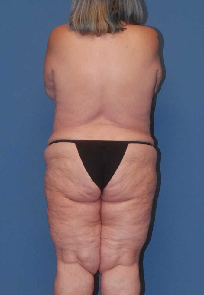 Abdominoplasty Before & After