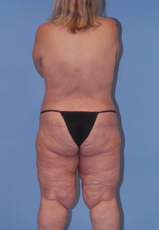 Abdominoplasty Before & After