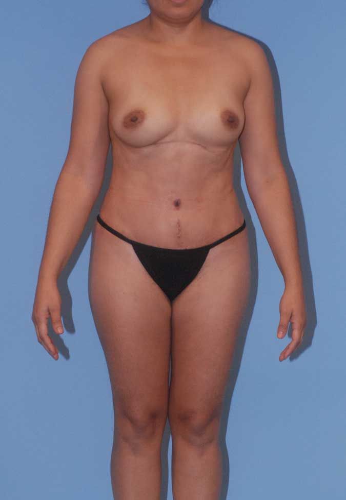 Abdominoplasty Before & After