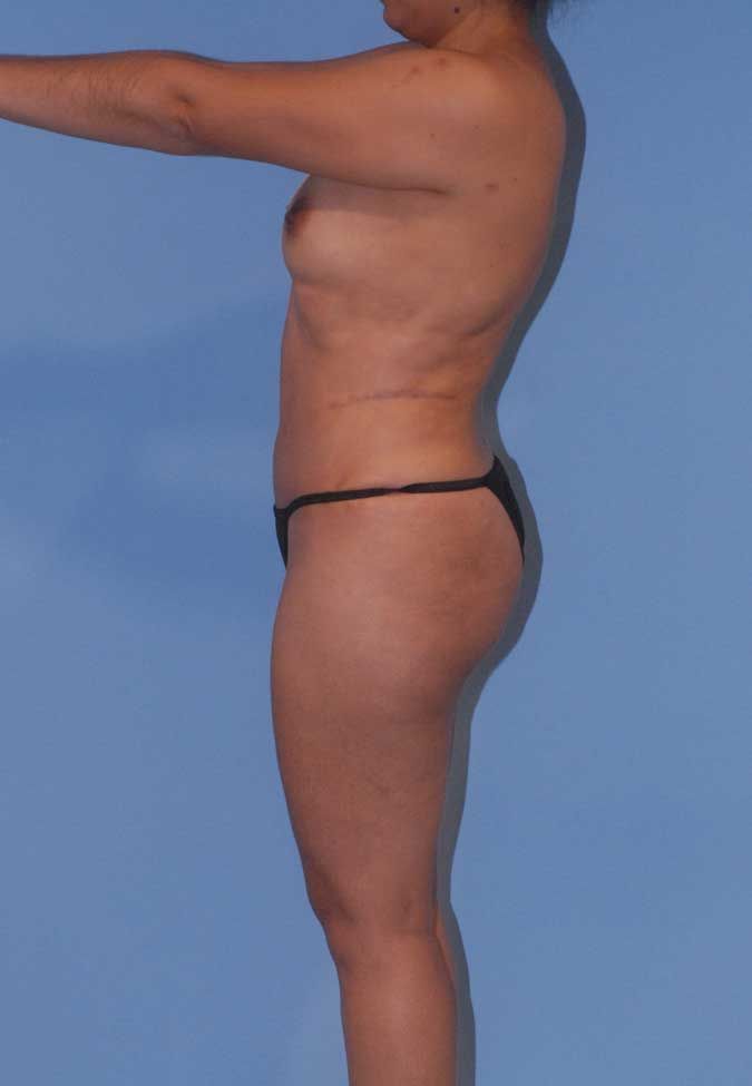 Abdominoplasty Before & After