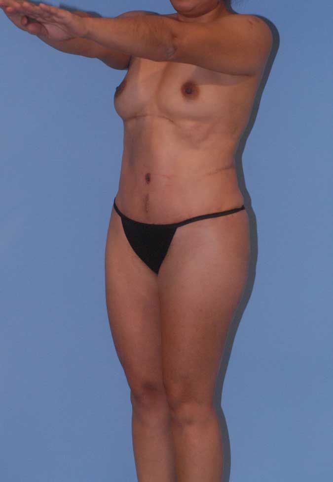 Abdominoplasty Before & After