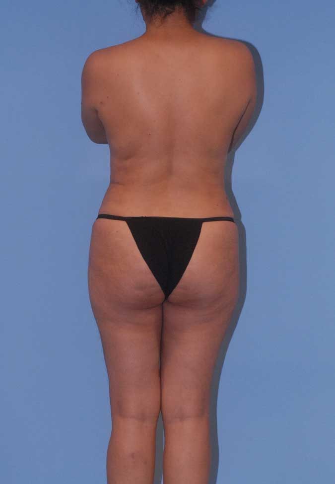 Abdominoplasty Before & After