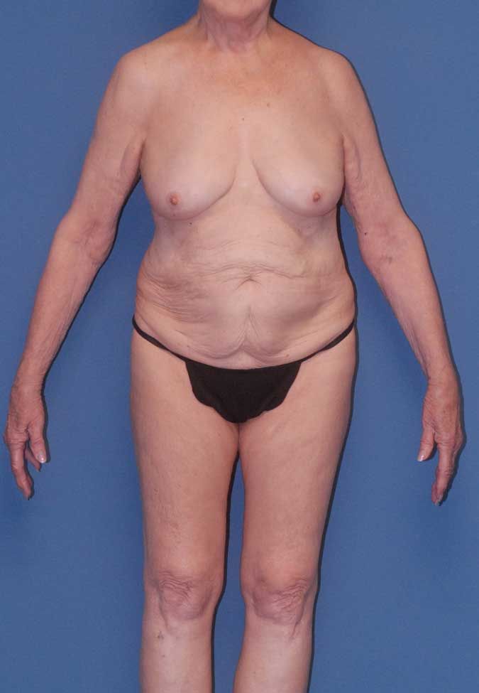 Abdominoplasty Before & After