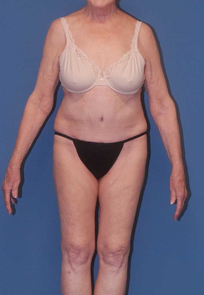 Abdominoplasty Before & After