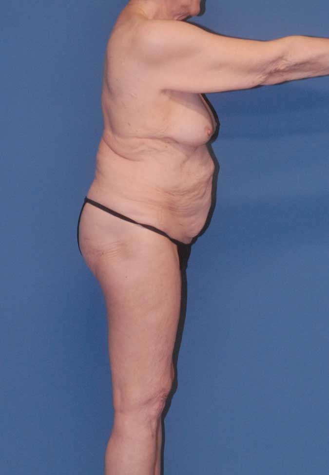 Abdominoplasty Before & After