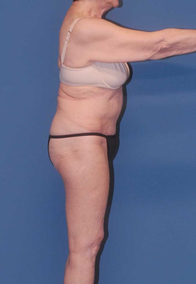 Abdominoplasty Before & After