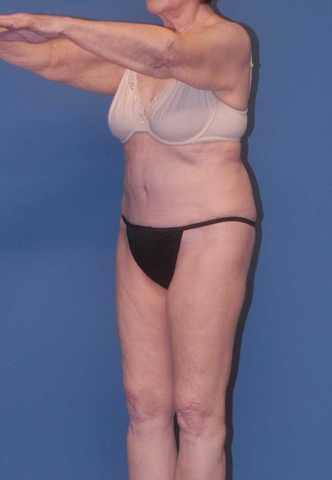 Abdominoplasty Before & After