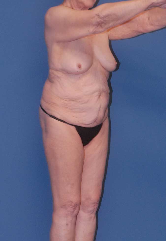 Abdominoplasty Before & After