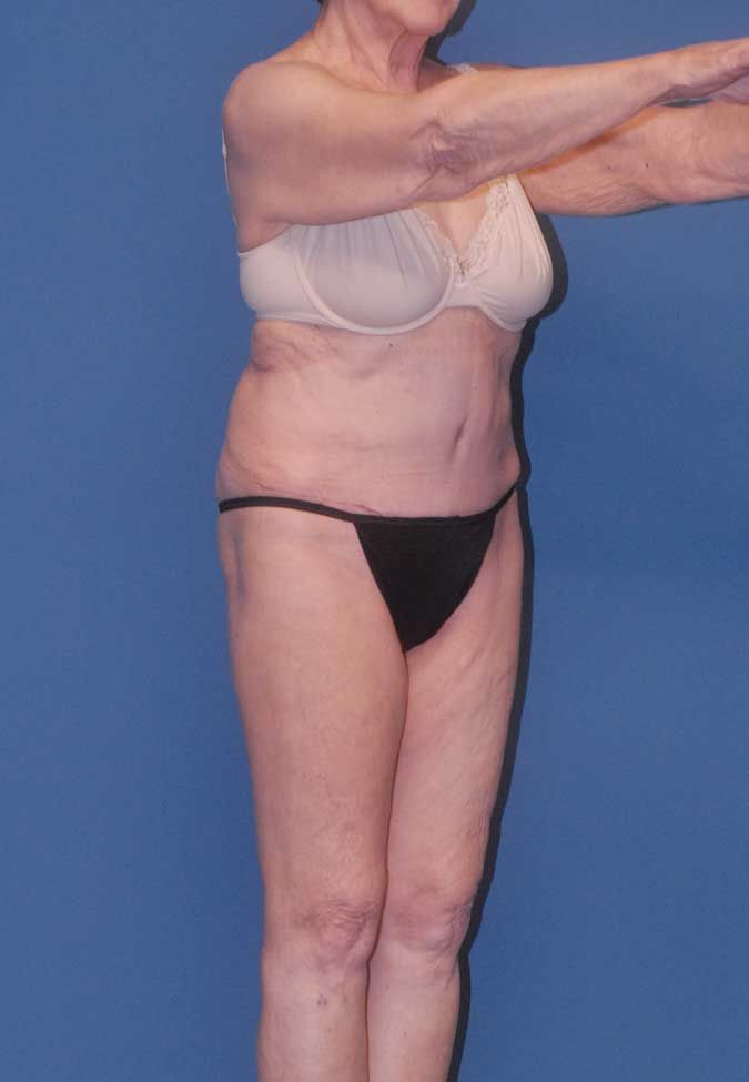 Abdominoplasty Before & After
