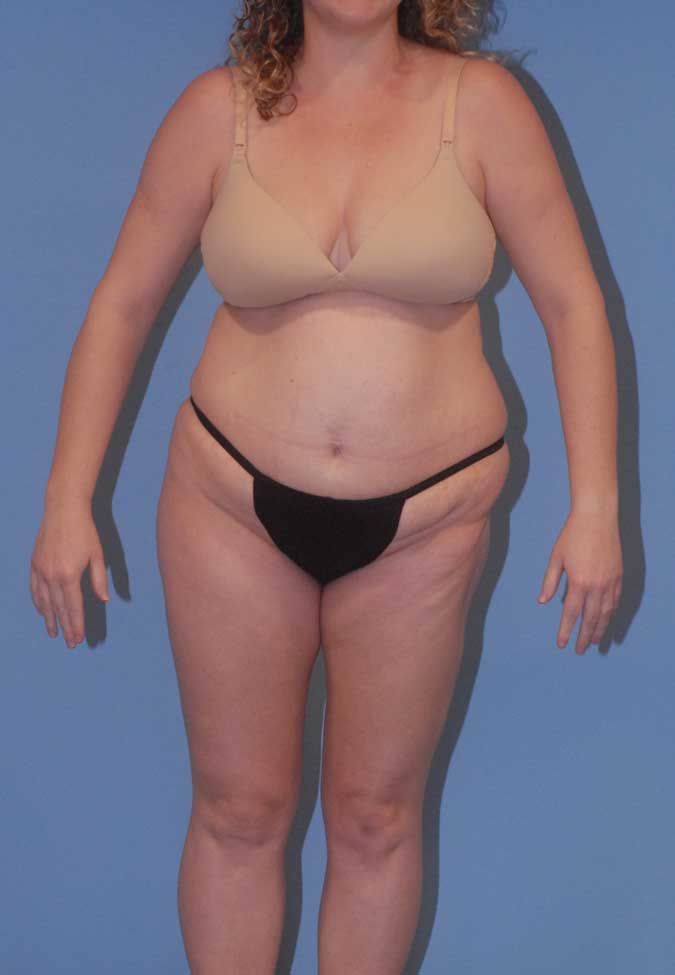 Abdominoplasty Before & After