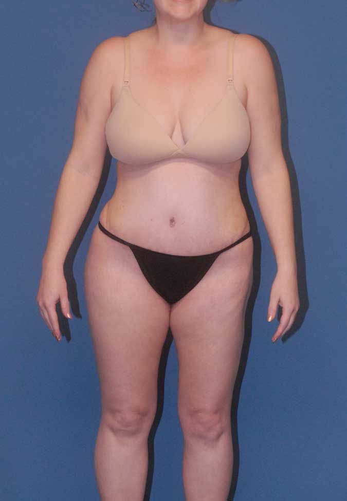 Abdominoplasty Before & After