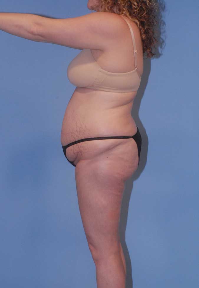 Abdominoplasty Before & After