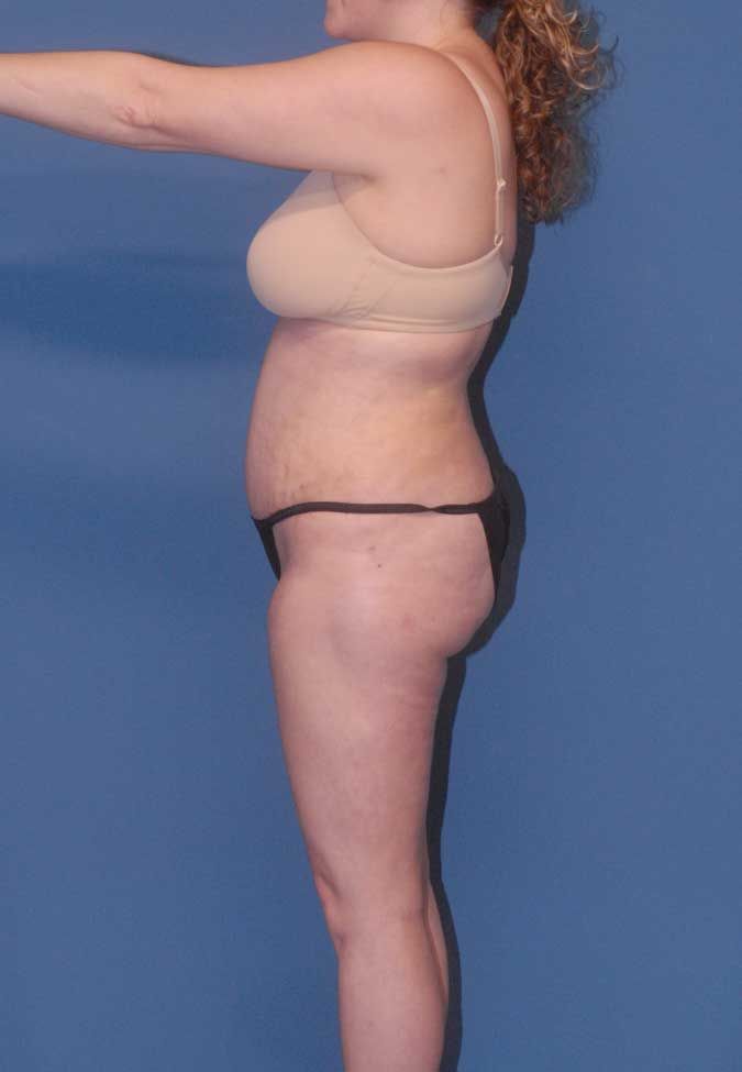 Abdominoplasty Before & After