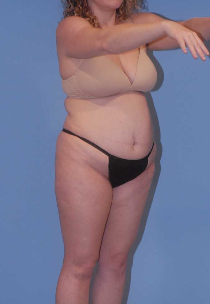 Abdominoplasty Before & After