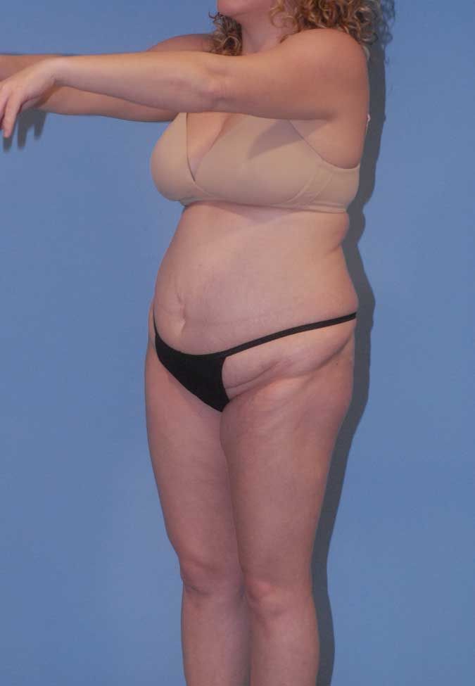 Abdominoplasty Before & After
