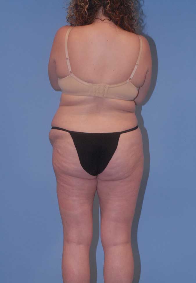 Abdominoplasty Before & After