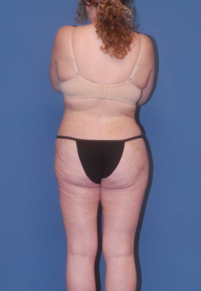 Abdominoplasty Before & After