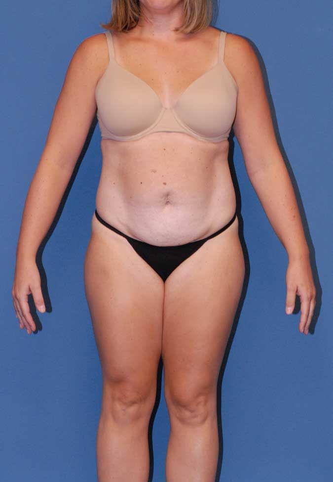Abdominoplasty Before & After
