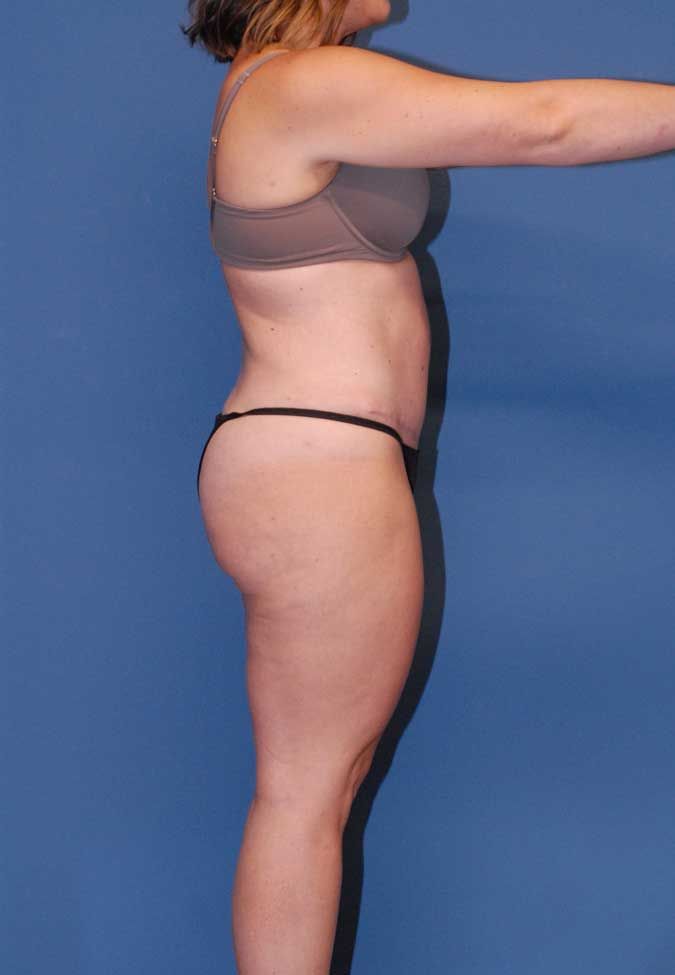 Abdominoplasty Before & After