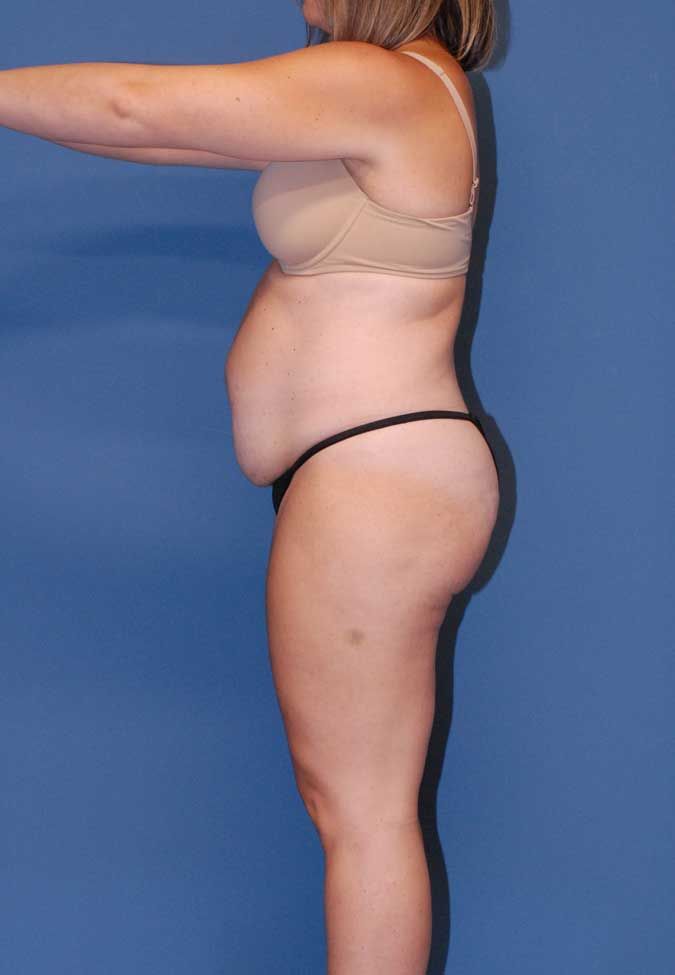 Abdominoplasty Before & After