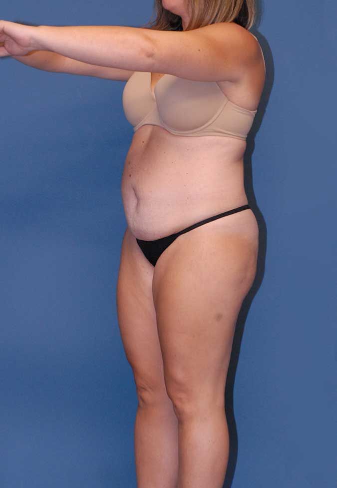 Abdominoplasty Before & After