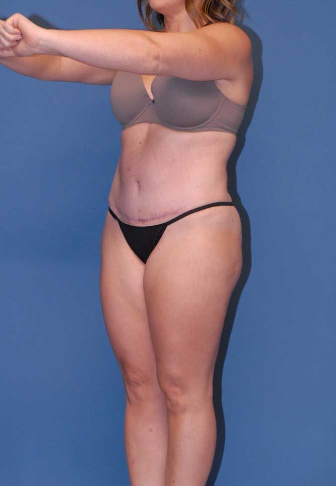 Abdominoplasty Before & After