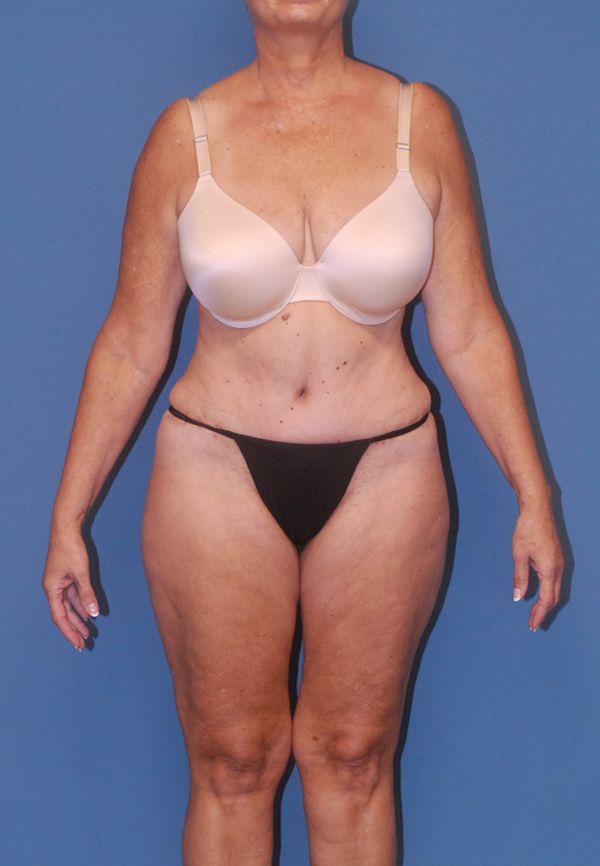 Abdominoplasty Before & After