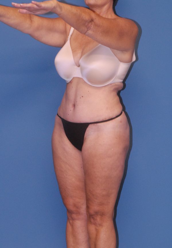 Abdominoplasty Before & After