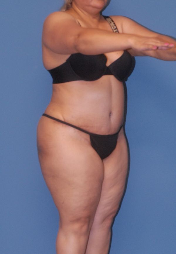 Abdominoplasty Before & After