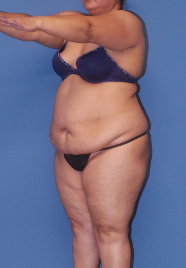 Abdominoplasty Before & After