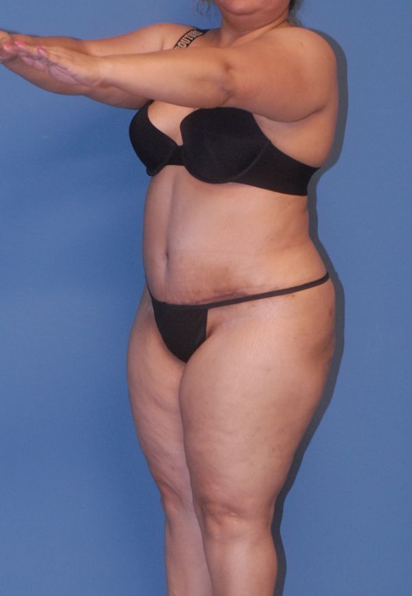 Abdominoplasty Before & After