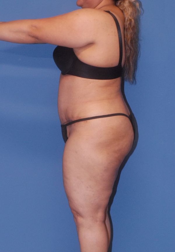 Abdominoplasty Before & After