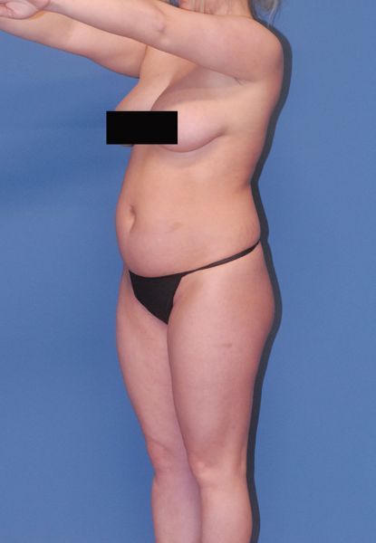 Abdominoplasty Before & After
