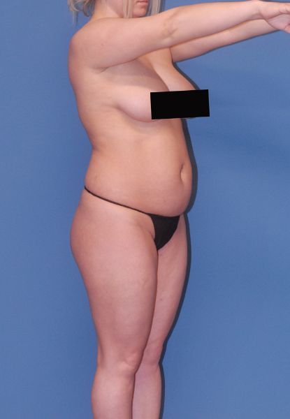 Abdominoplasty Before & After