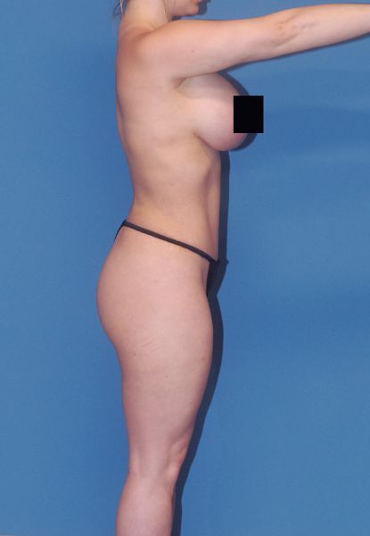 Abdominoplasty Before & After
